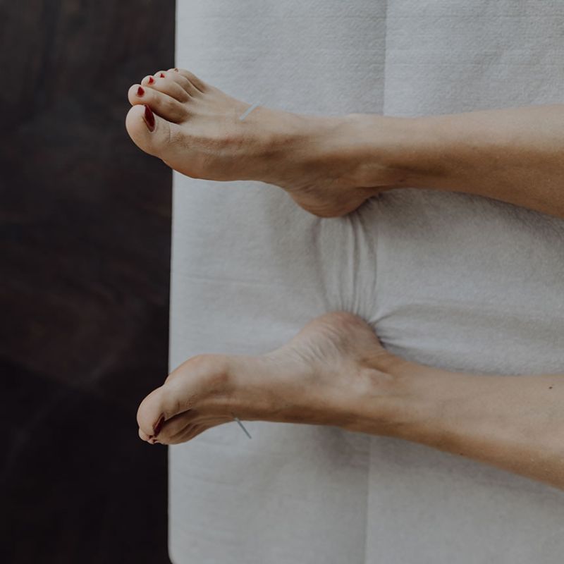 Akupunkturnadeln stecken im Fuss einer Patientin, um Beschwerden in der Schwangerschaft zu reduzieren.