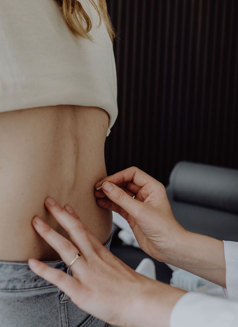 Gynäkologin Dr. med. Rieke Hermann setzt eine Akupunktur Nadel um Beschwerden zu lindern